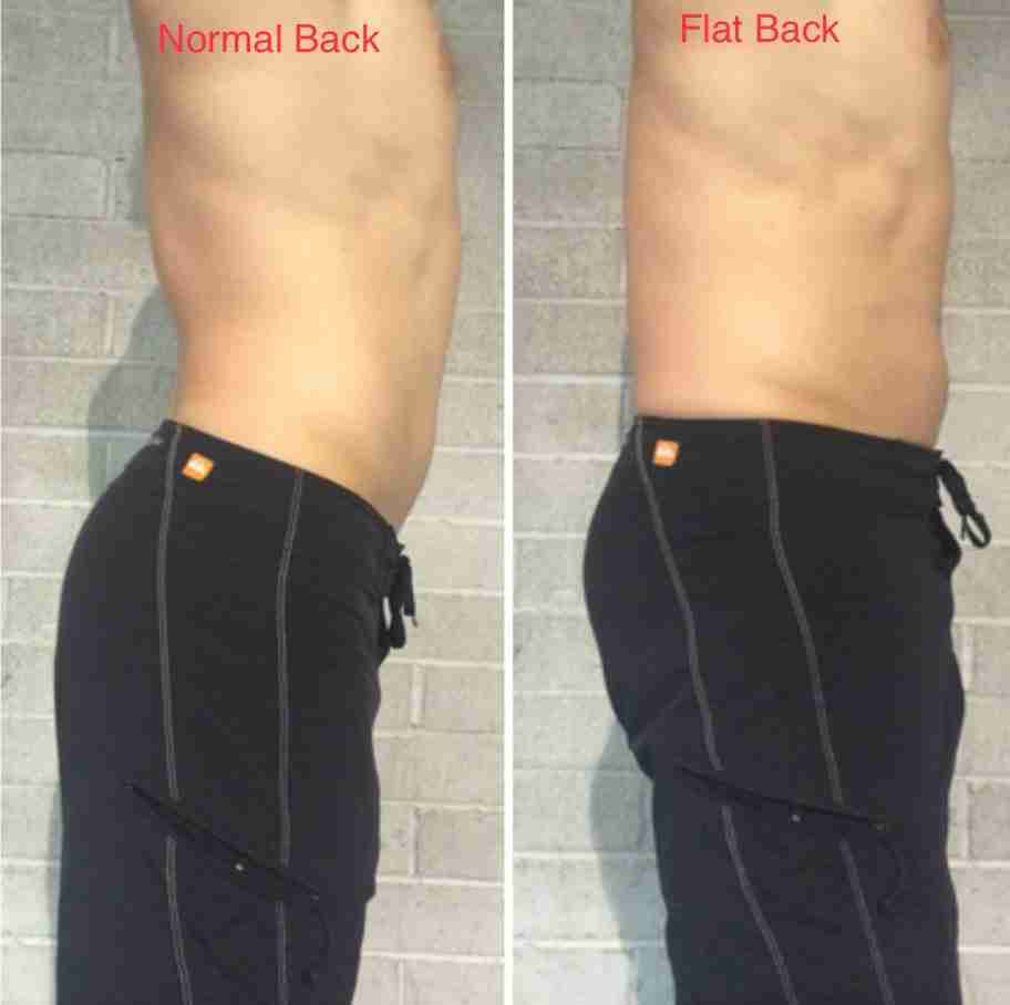 Flat Back Posture