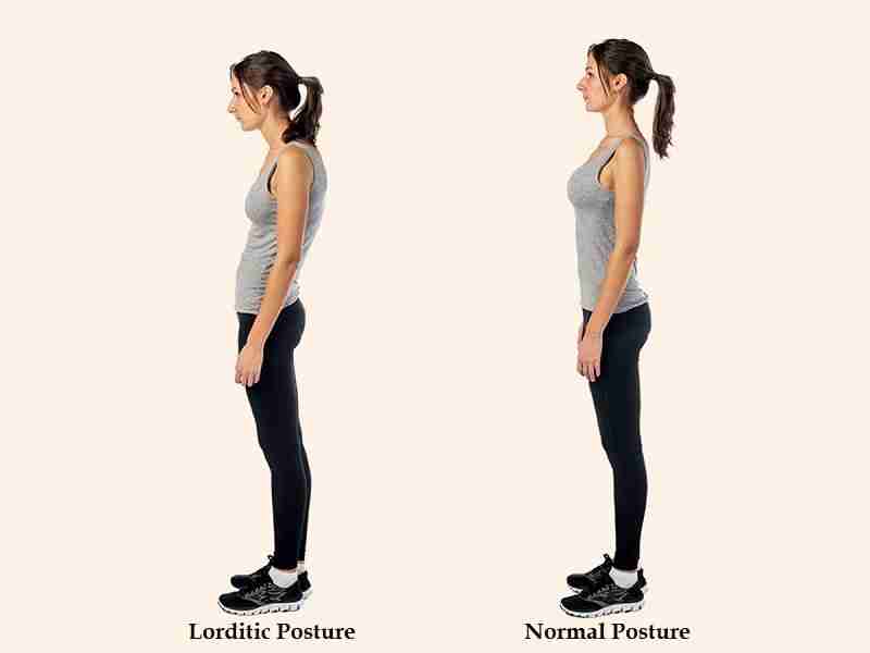 Lordotic Posture