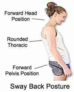 Sway back Postural defect
